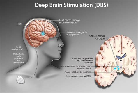 dbs sex|The Impact of Deep Brain Stimulation on the Sexual Function of .